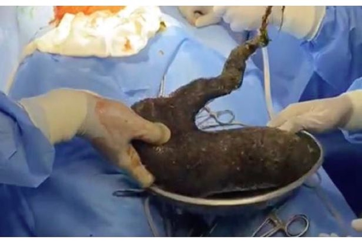 युवती के पेट से निकले दो किलो बाल, पेट में इतनी मात्रा में कैसे पहुंचे? जानें