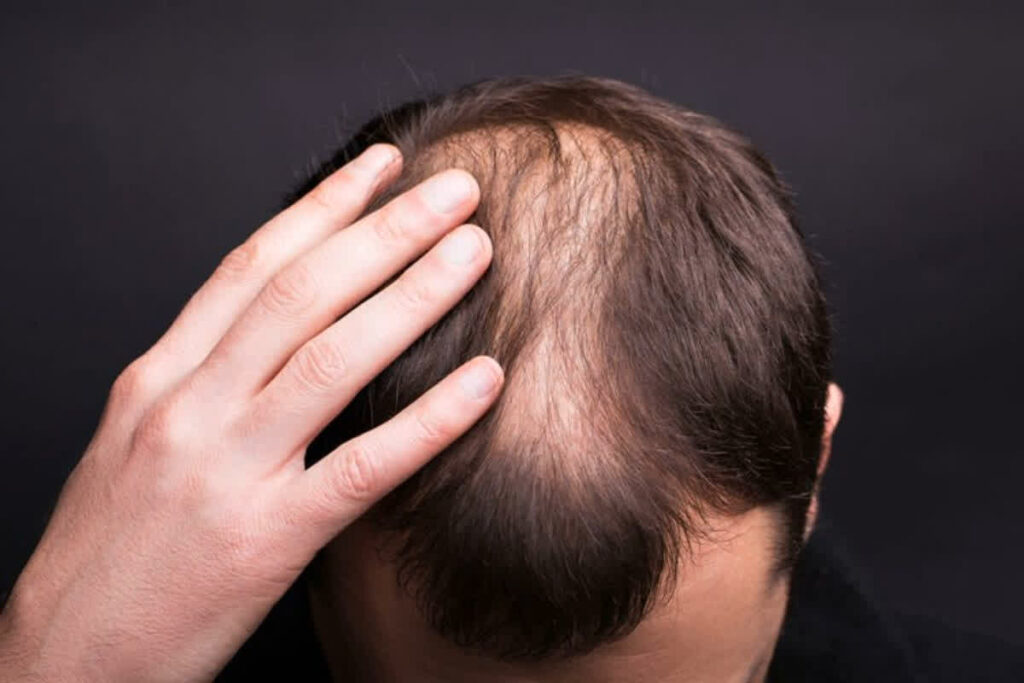 best diet for baldness