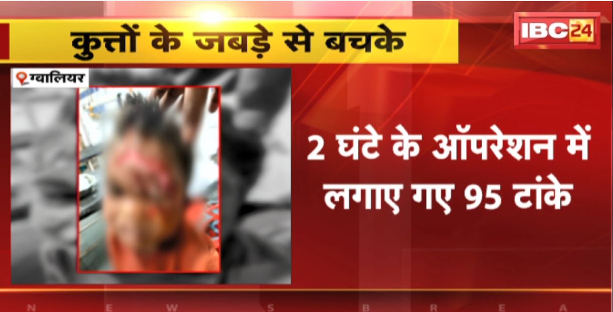 Gwalior Dog Attack News: स्ट्रीट डॉग ने मासूम को नोचा। 2 घंटे के ऑपरेशन में मासूम को लगाए गए 95 टांके