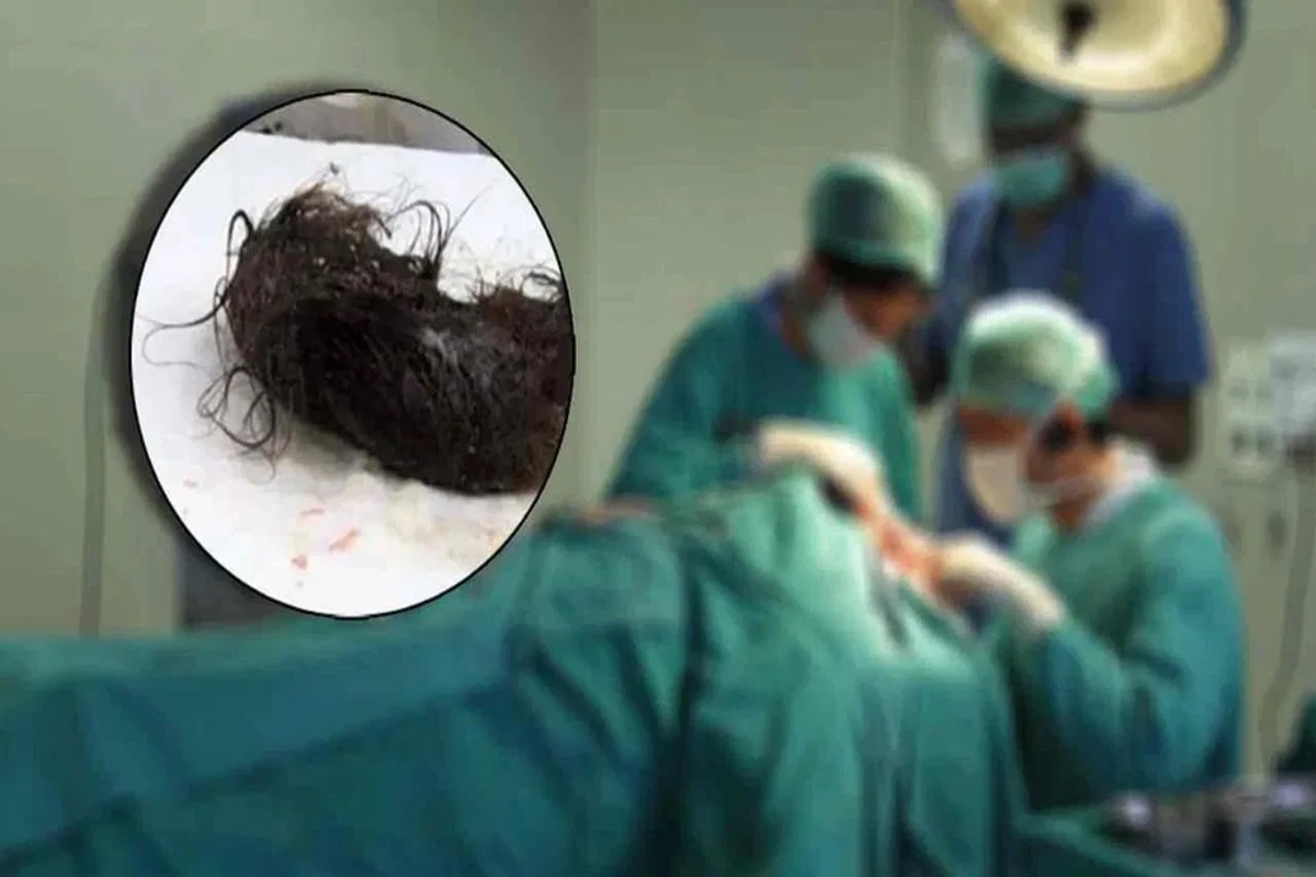 Maharashtra News: अपने ही बालों को खा जाती थी 10 साल की ये बच्ची, अस्पताल पहुंची तो डॉक्टरों के उड़े होश, सर्जरी के बाद निकाला गया इतने किलो का गुच्छा