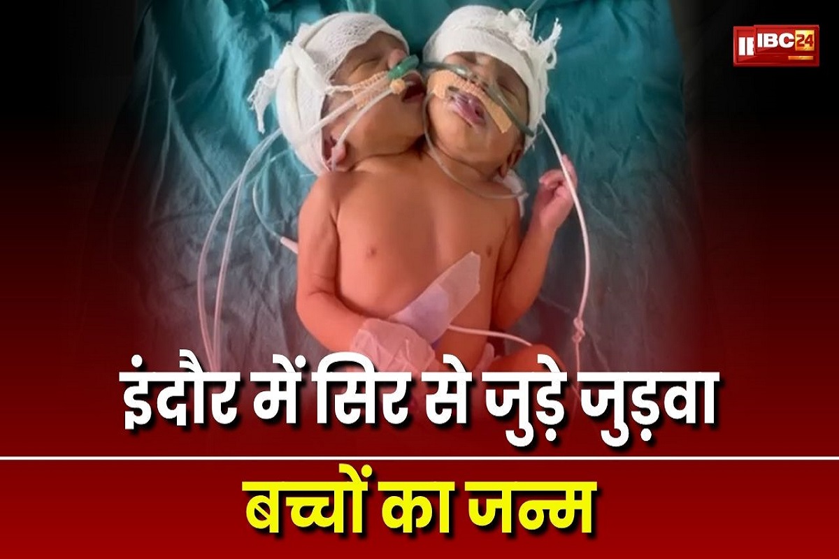 Indore News: एक जिस्म दो जान! इंदौर में दो सिर वाले जुड़वा बच्ची का हुआ जन्म, देखकर डॉक्टर भी रह गए हैरान