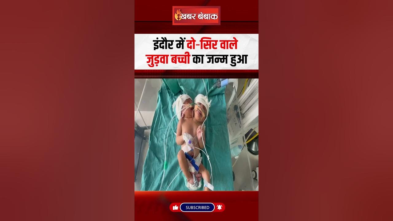 Indore में दो‑सिर वाले जुड़वा बच्ची का जन्म हुआ!
