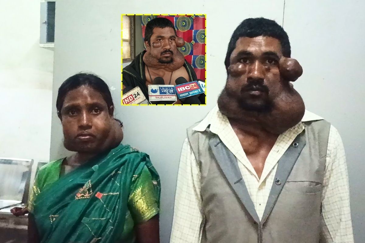 Dindori News: 15 साल से चेहरा छुपाकर घूम रहा है ये शख्स, विरासत में मिली दुर्लभ बीमारी, जानकर आप भी हैरान रह जाएंगे