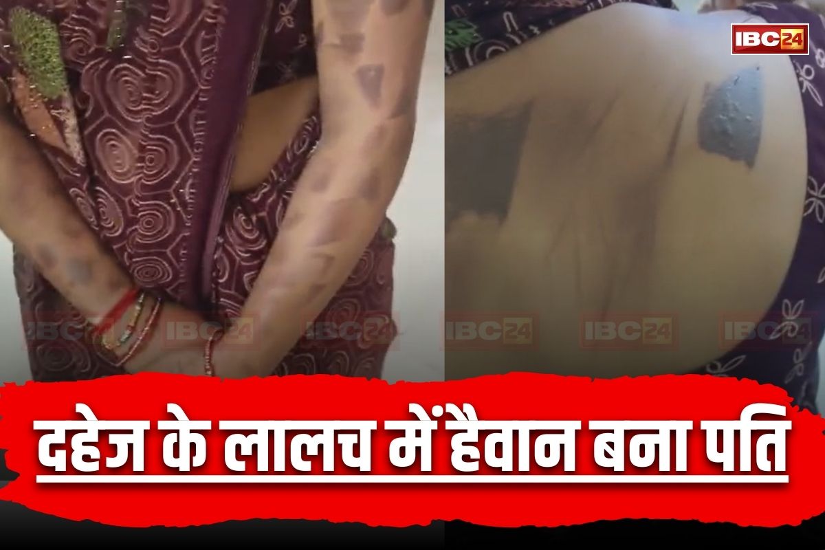MP News: दहेज के लालच में हैवान बना पति, पहले पत्नी से की मारपीट, फिर गर्म चाकू से पूरे शरीर को दागा