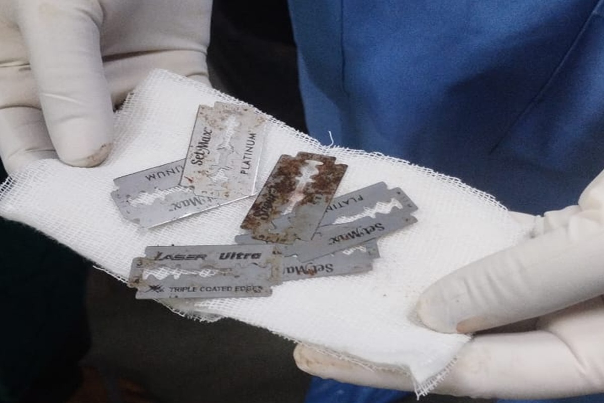 Bilaspur News: बुजुर्ग के गले से डॉक्टरों ने ऑपरेशन कर निकाले आधा दर्जन ब्लेड, देखकर हैरान रह गए लोग