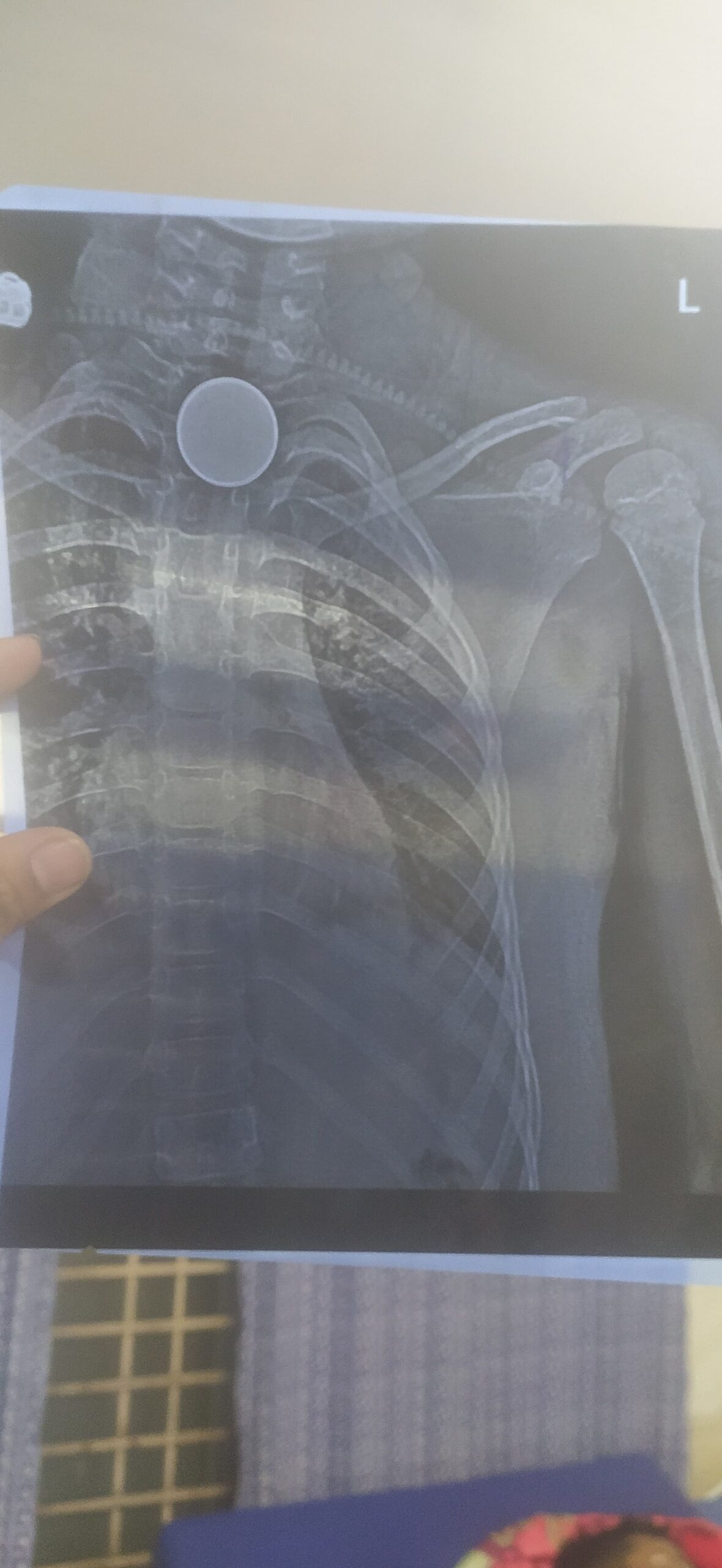 Korba News : खेलते-खेलते मासूम ने निगल लिया सिक्का, अस्पताल में समय पर नहीं मिला इलाज तो तोड़ा दम, परिवार में पसरा मातम