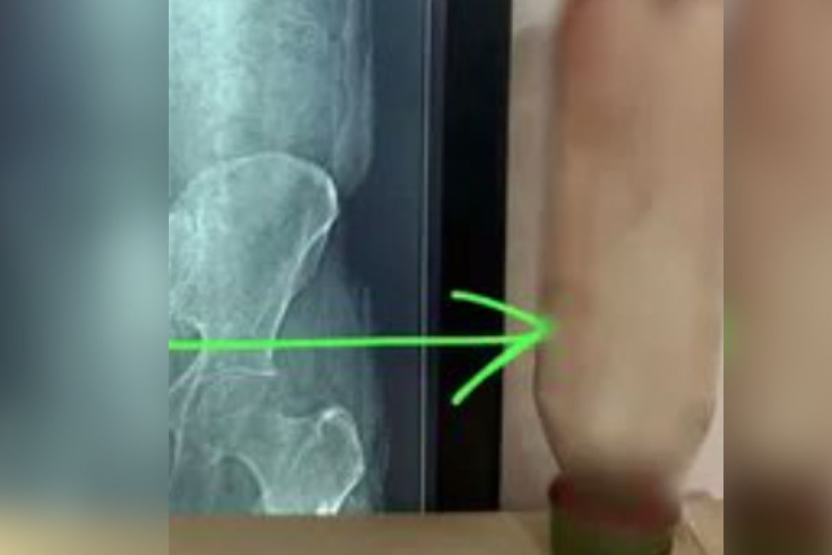 Man Inserted Bottle in Anus : यौन आनंद की सनक पड़ी भारी! युवक ने  मलाशय में घुसा ली ऐसी चीज़,  X-रे देख डॉक्टरों के उड़ गए होश, सर्जरी के बाद हुआ चौंकाने वाला खुलासा