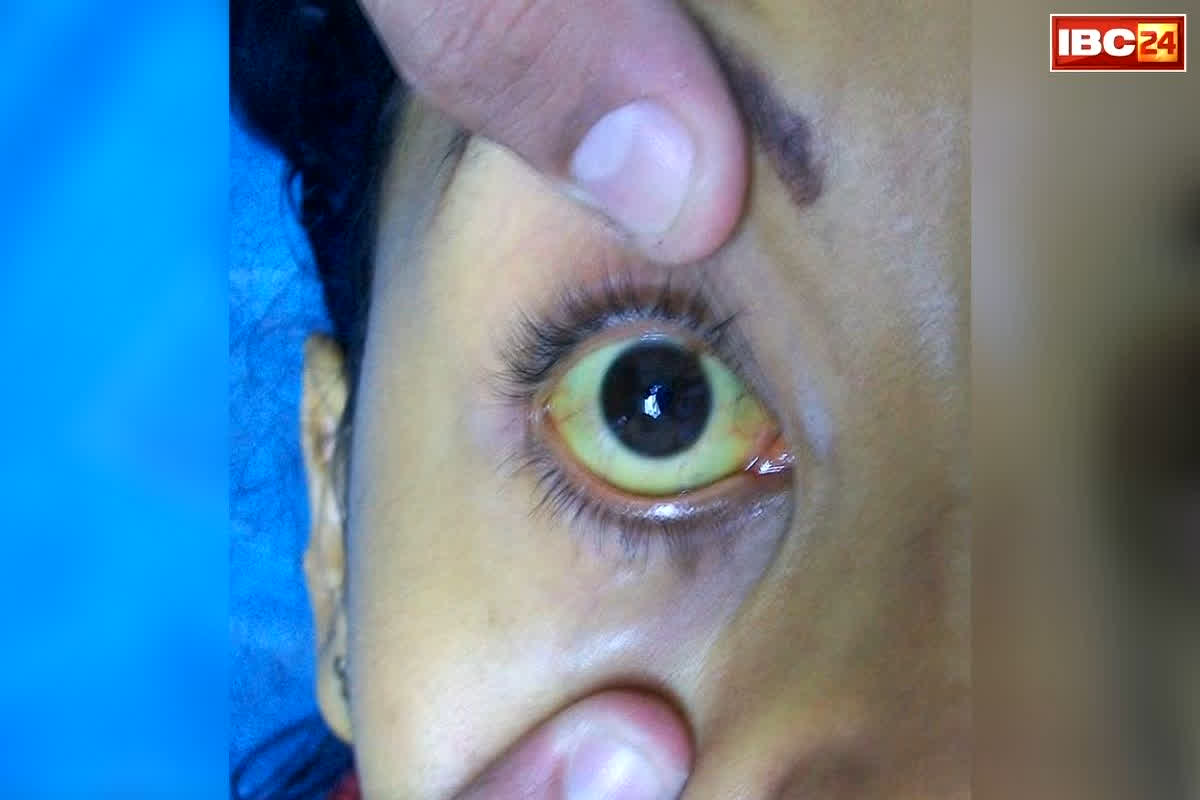 Bhilai Peelia Case: भिलाई टाउनशिप में फैलता जा रहा ‘पीलिया का कहर’! 4 दिन में 31 मरीज, अब स्वास्थ्य विभाग ने लिया ये बड़ा एक्शन