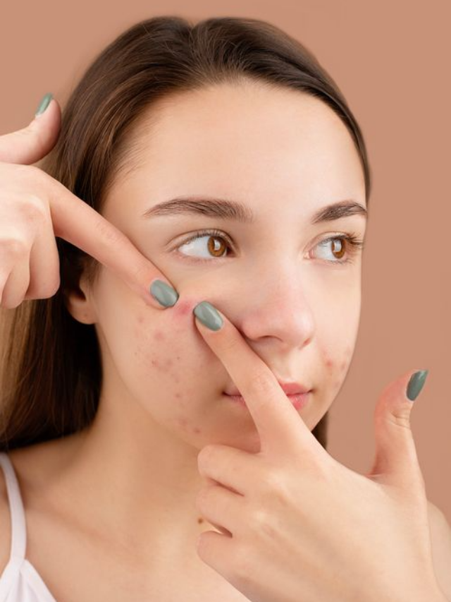 Acne Treatment Tips : पिंपल्स से हैं परेशान? रात में करें ये 5 काम, सुबह मिलेगी साफ स्किन