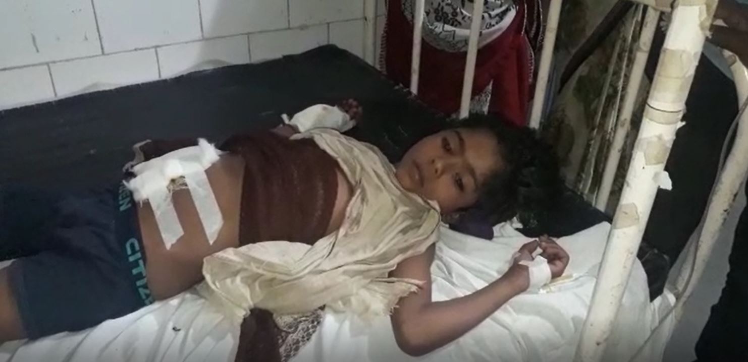 मोबाइल बैटरी फटने से तीन बच्चे घायल
